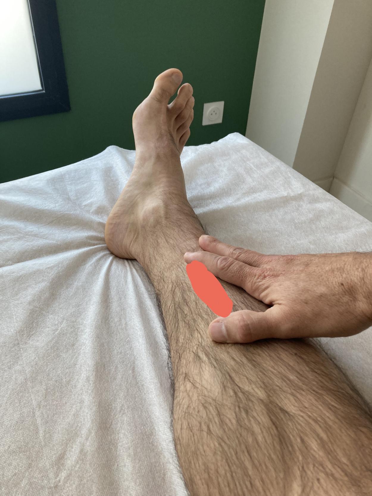 Photo Périostite tibiale: comprendre, prévenir et traiter